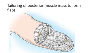 Tailoring of posterior muscle mass to form
flaps
 