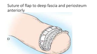 Suture of flap to deep fascia and periosteum
anteriorly
 