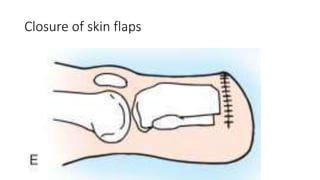 Closure of skin flaps
 