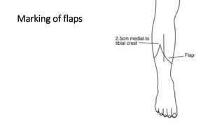 Marking of flaps
 