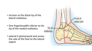 • Incision at the distal tip of the
lateral malleolus
• One fingerbreadth inferior to the
tip of the medial malleolus
• extend it plantarward and across
the sole of the foot to the lateral
aspect
 