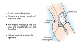 • Foot in marked equinus
• Divide the anterior capsule of
the ankle joint
• b/w medial malleolus and the
talus and lateral malleolus and
the talus
• Deltoid and calcaneofibular
ligament
 