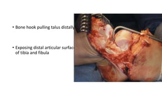 • Bone hook pulling talus distally,
• Exposing distal articular surface
of tibia and fibula
 