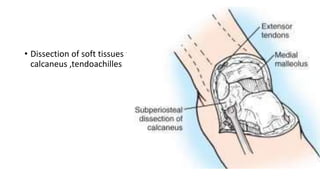 • Dissection of soft tissues from
calcaneus ,tendoachilles
 