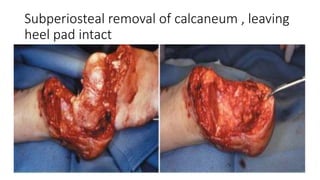Subperiosteal removal of calcaneum , leaving
heel pad intact
 