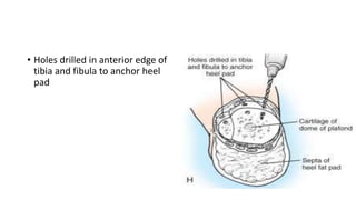 • Holes drilled in anterior edge of
tibia and fibula to anchor heel
pad
 