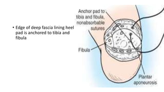 • Edge of deep fascia lining heel
pad is anchored to tibia and
fibula
 