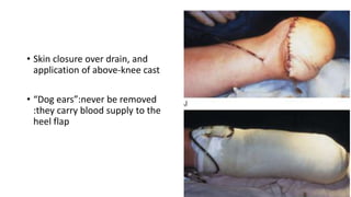 • Skin closure over drain, and
application of above-knee cast
• “Dog ears”:never be removed
:they carry blood supply to the
heel flap
 