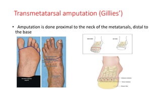 Transmetatarsal amputation (Gillies’)
• Amputation is done proximal to the neck of the metatarsals, distal to
the base
 