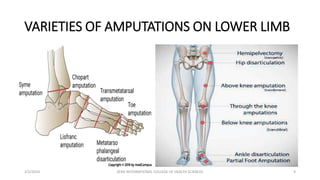 VARIETIES OF AMPUTATIONS ON LOWER LIMB
2/2/2024 ZERA INTERNATIONAL COLLEGE OF HEALTH SCIENCES 9
 