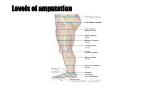 Levels of amputation
 