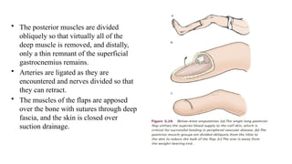 • The posterior muscles are divided
obliquely so that virtually all of the
deep muscle is removed, and distally,
only a thin remnant of the superficial
gastrocnemius remains.
• Arteries are ligated as they are
encountered and nerves divided so that
they can retract.
• The muscles of the flaps are apposed
over the bone with sutures through deep
fascia, and the skin is closed over
suction drainage.
 