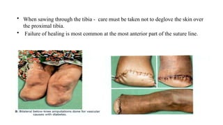 • When sawing through the tibia - care must be taken not to deglove the skin over
the proximal tibia.
• Failure of healing is most common at the most anterior part of the suture line.
 