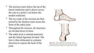 • The incision starts below the tip of the
lateral malleolus and is drawn across
the sole to a point 2 cm below the
medial malleolus.
• The two ends of the incision are then
joined by the shortest route across the
front of the ankle joint.
• Throughout the incision, all structures
are divided down to bone.
• The ankle joint is entered anteriorly
and the lateral ligament divided. The
foot is then dislocated in a plantar
direction to expose the back of the
joint.
 