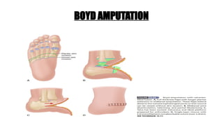 BOYD AMPUTATION
 