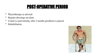 POST-OPERATIVE PERIOD
• Physiotherapy as advised.
• Regular dressings are done.
• Crutch is used initially, after 3 months prosthesis is placed.
• Rehabilitation.
 