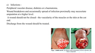 c) Infections :
Peripheral vascular disease, diabetes or a haematoma.
Wound breakdown and occasionally spread of infection proximally may necessitate
amputation at a higher level.
A wound should not be closed - the vascularity of the muscles or the skin at the cut
end.
Discharge from the wound should be treated.
 
