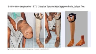 Below-knee amputation - PTB (Patellar Tendon Bearing) prosthesis, Jaipur foot
 