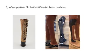 Syme's amputation - Elephant boot,Canadian Syme's prosthesis.
 