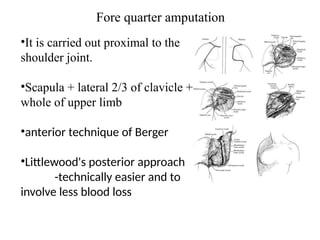 Fore quarter amputation
•It is carried out proximal to the
shoulder joint.
•Scapula + lateral 2/3 of clavicle +
whole of upper limb
•anterior technique of Berger
•Littlewood's posterior approach
-technically easier and to
involve less blood loss
 