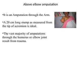 Above elbow amputation
•It is an Amputation through the Arm.
•A 20 cm long stump as measured from
the tip of acromion is ideal.
•The vast majority of amputations
through the humerus or elbow joint
result from trauma.
 