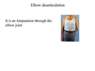 Elbow disarticulation
It is an Amputation through the
elbow joint
 