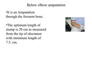 Below elbow amputation
•It is an Amputation
through the forearm bone.
•The optimum length of
stump is 20 cm as measured
from the tip of olecranon
with minimum length of
7.5. cm.
 