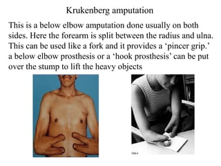 Krukenberg amputation
This is a below elbow amputation done usually on both
sides. Here the forearm is split between the radius and ulna.
This can be used like a fork and it provides a ‘pincer grip.’
a below elbow prosthesis or a ‘hook prosthesis’ can be put
over the stump to lift the heavy objects
 