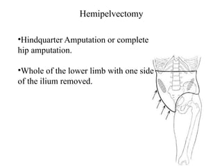 Hemipelvectomy
•Hindquarter Amputation or complete
hip amputation.
•Whole of the lower limb with one side
of the ilium removed.
 
