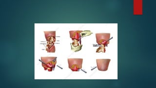 Amputations Types and management and Physiotherapy | PPTX