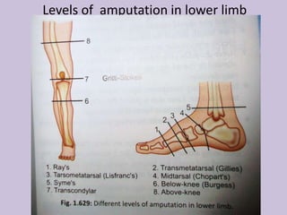 Different amputations
• Above knee A/K amputation- Equal anterior and
posterior flaps, ideal femur stump should be 25 cms
...