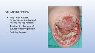 AMPUTATIONS AND DISARTICULATIONS PRESENTATION | PPTX