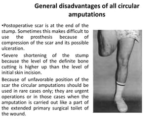 Comprehensive Guide to Lower Limb Amputations and Disarticulations ...