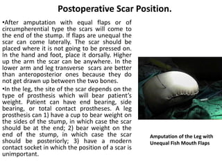 Scar Prothesis Comprehensive Guide to Lower Limb Amputations and Disarticulations ...