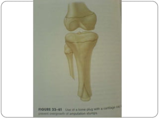  Prosthesis replaced every 12-24
  months when worn out
 Examined every 3-6 months
 Size
 Length
 Weight of patient
...