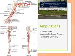 Amputations
Dr Imran Javed.
Associate Professor Surgery.
Fiji National University.
 
