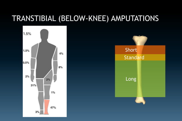 Amputations of the lower extremity | PPTX | Death, Injury, or Military ...