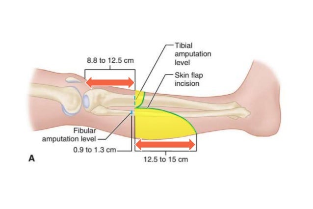 Amputations Of The Lower Extremity