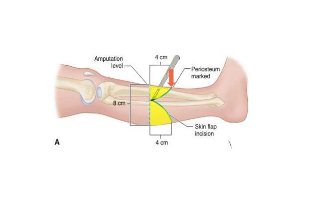 transtibial amputation