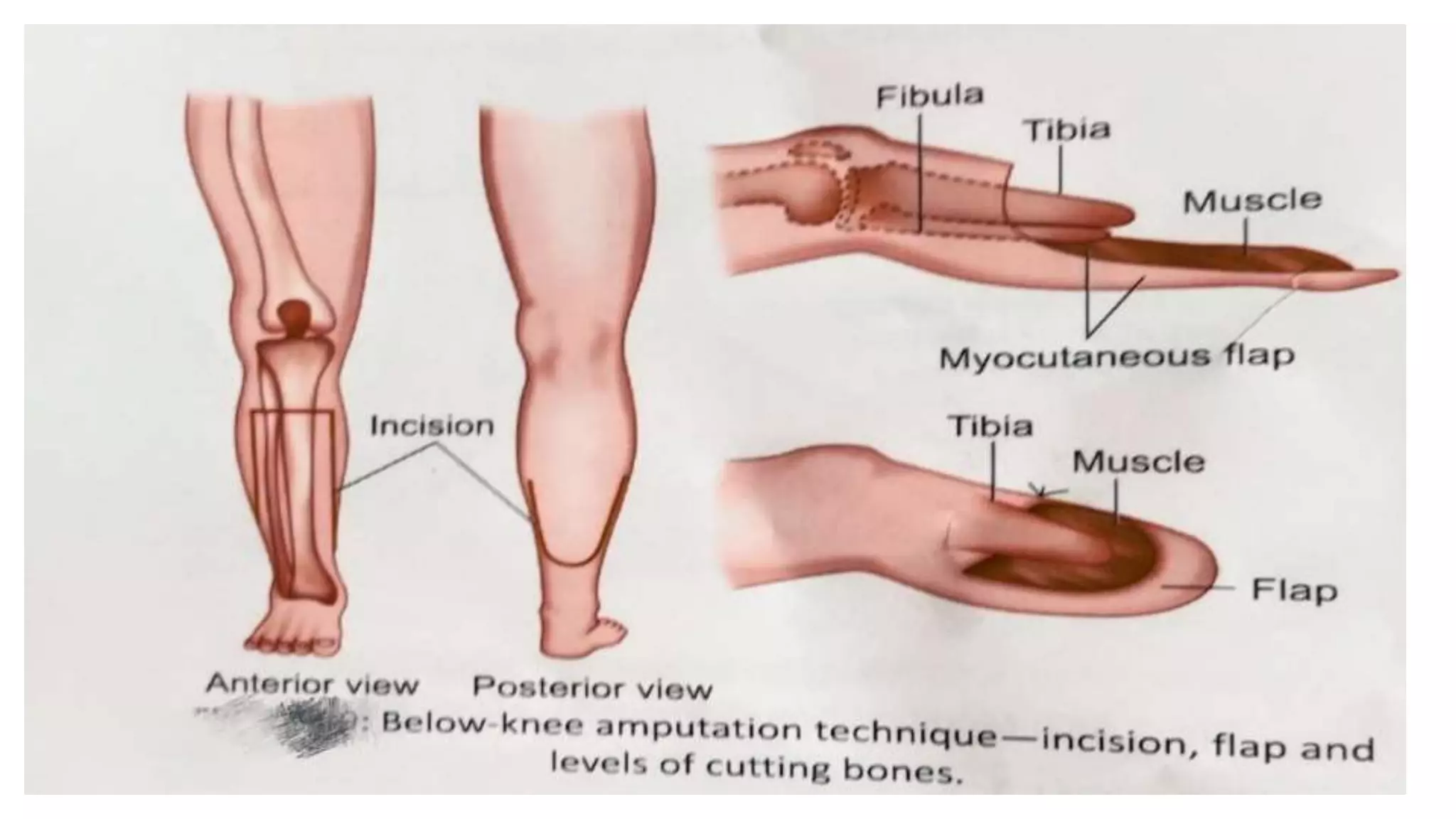AMPUTATIONS Ppt pptx amputations-ppt-pptx