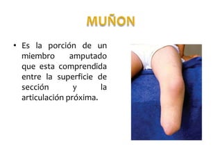 • Es la porción de un
miembro
amputado
que esta comprendida
entre la superficie de
sección
y
la
articulación próxima.

 