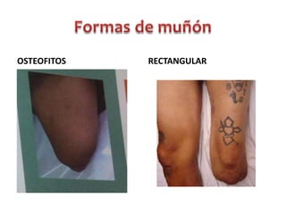 OSTEOFITOS

RECTANGULAR

 