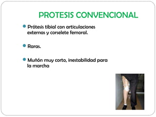 PROTESIS CONVENCIONAL
Prótesis tibial con articulaciones
externas y corselete femoral.
Raras.
Muñón muy corto, inestabi...