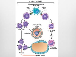 Antibody mediated rejection pathology histopathology | PPTX