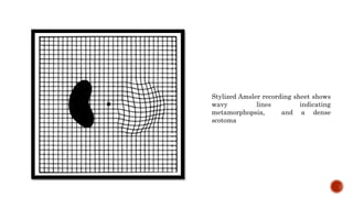 Stylized Amsler recording sheet shows
wavy lines indicating
metamorphopsia, and a dense
scotoma
 