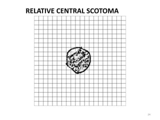 24
RELATIVE CENTRAL SCOTOMA
 
