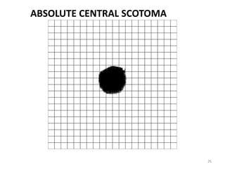 26
ABSOLUTE CENTRAL SCOTOMA
 