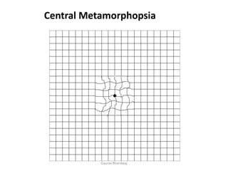 Gaurav Bhardwaj
Central Metamorphopsia
 