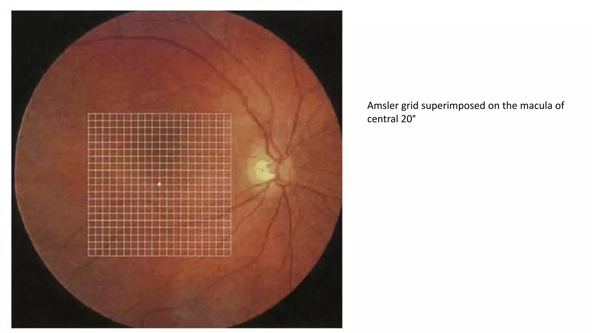 Amsler grid superimposed on the macula of
central 20°
 