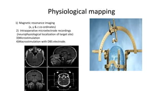 Physiological mapping
.
• S it1) Magnetic resonance imaging
(x, y & z co-ordinates)
2) Intraoperative microelectrode recordings
(neurophysiological localization of target site)
3)Microstimulation
4)Macrostimulation with DBS electrode.
(stimulation of
 